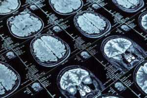 Esperança no combate contra o Alzheimer: rigor científico - 04/05/2026 - Equilíbrio e Saúde