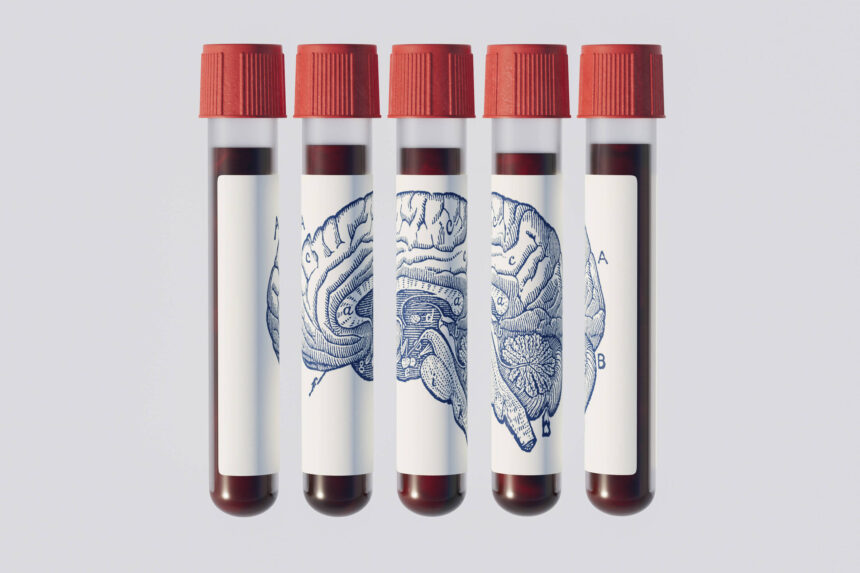 Alzheimer: exame de sangue prevê demência 20 anos antes - 12/06/2026 - Equilíbrio e Saúde