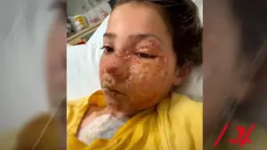 Menina de 10 anos sofre queimaduras no rosto após fazer desafio do TikTok