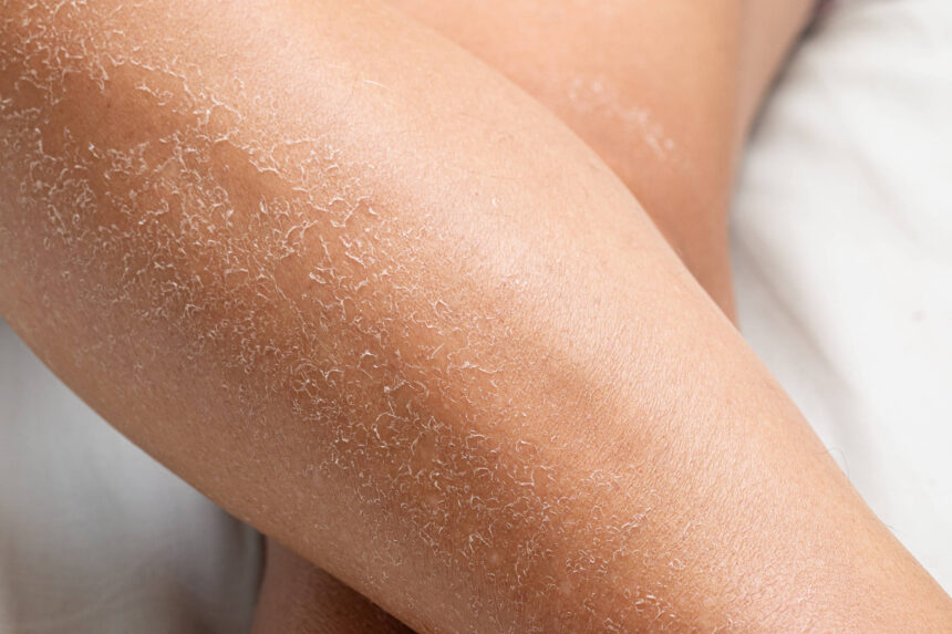 Pele seca no inverno: dermatologistas dão dicas - 06/07/2026 - Equilíbrio