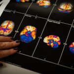 Alzheimer: relato de melhora com cogumelos mágicos - 09/07/2026 - Virada Psicodélica