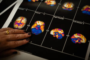 Alzheimer: relato de melhora com cogumelos mágicos - 09/07/2026 - Virada Psicodélica