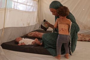 Catapora se espalha por acampamentos de Gaza - 21/07/2026 - Equilíbrio e Saúde