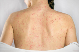 Eletroacupuntura pode aliviar dor após herpes-zóster - 11/10/2026 - Equilíbrio e Saúde